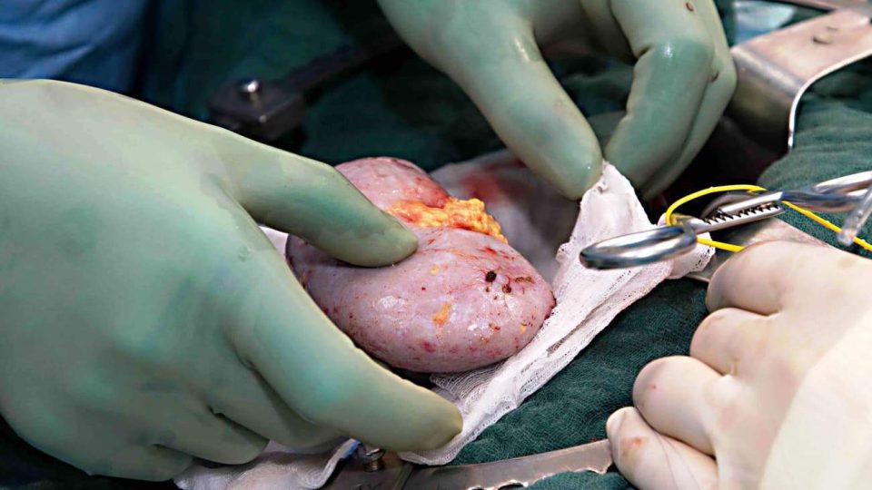 एम्स रायपुर में सफलतापूर्वक हुआ स्वैप किडनी ट्रांसप्लांट